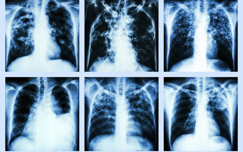 Diagnosis of Pericardial Effusion