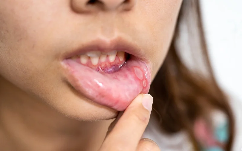 How Long Do Canker Sores Last